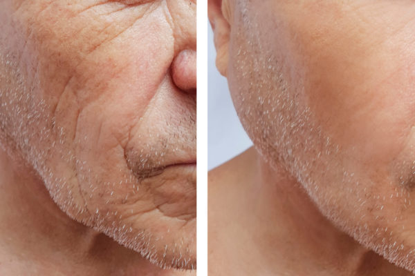 Face,Of,An,Elderly,Man,Wrinkles,Face,Before,And,After