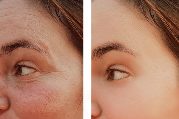 Wrinkles,Of,An,Eye,Woman's,Face,Before,And,After,Cosmetic