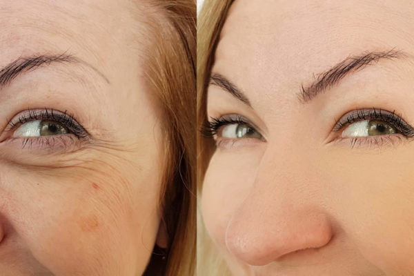 Woman,Face,Wrinkles,After,Treatment