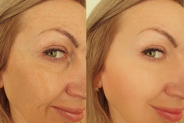 Woman,Face,Wrinkles,After,Treatment